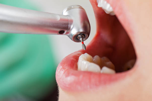 Best Emergency Dentist for Knocked-Out Tooth in Sonora, CA